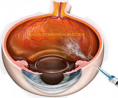 Efficacy and safety of ‘dropless vitrectomy surgery’ and comparison of outcomes to standard of care topical therapy